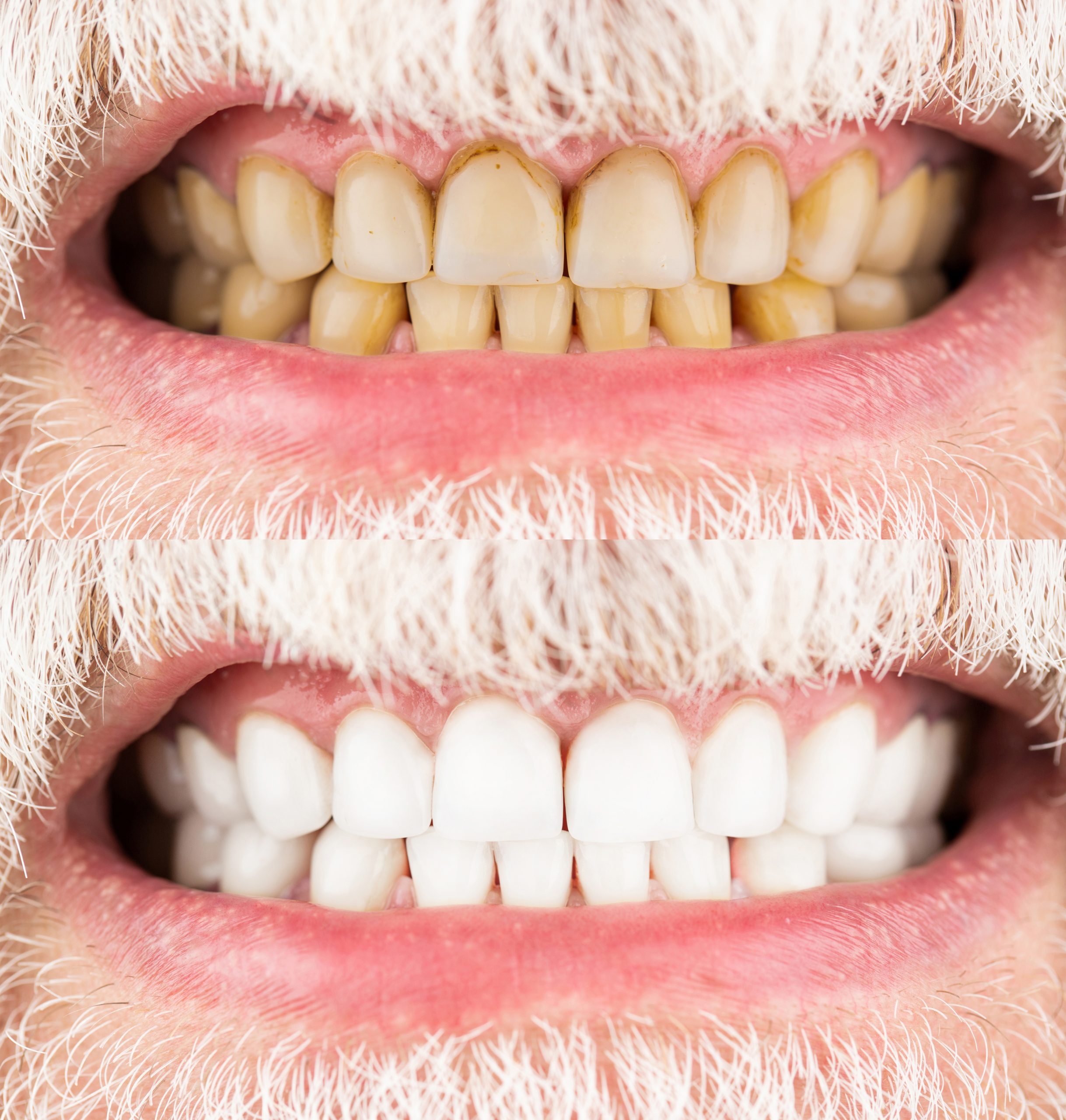 Male teeth before and after whitening, oral care dentistry, stomatology. Smiling man before and after teeth whitening procedure, closeup. Close-up Of A Smiling man Teeth Before And After Whitening.