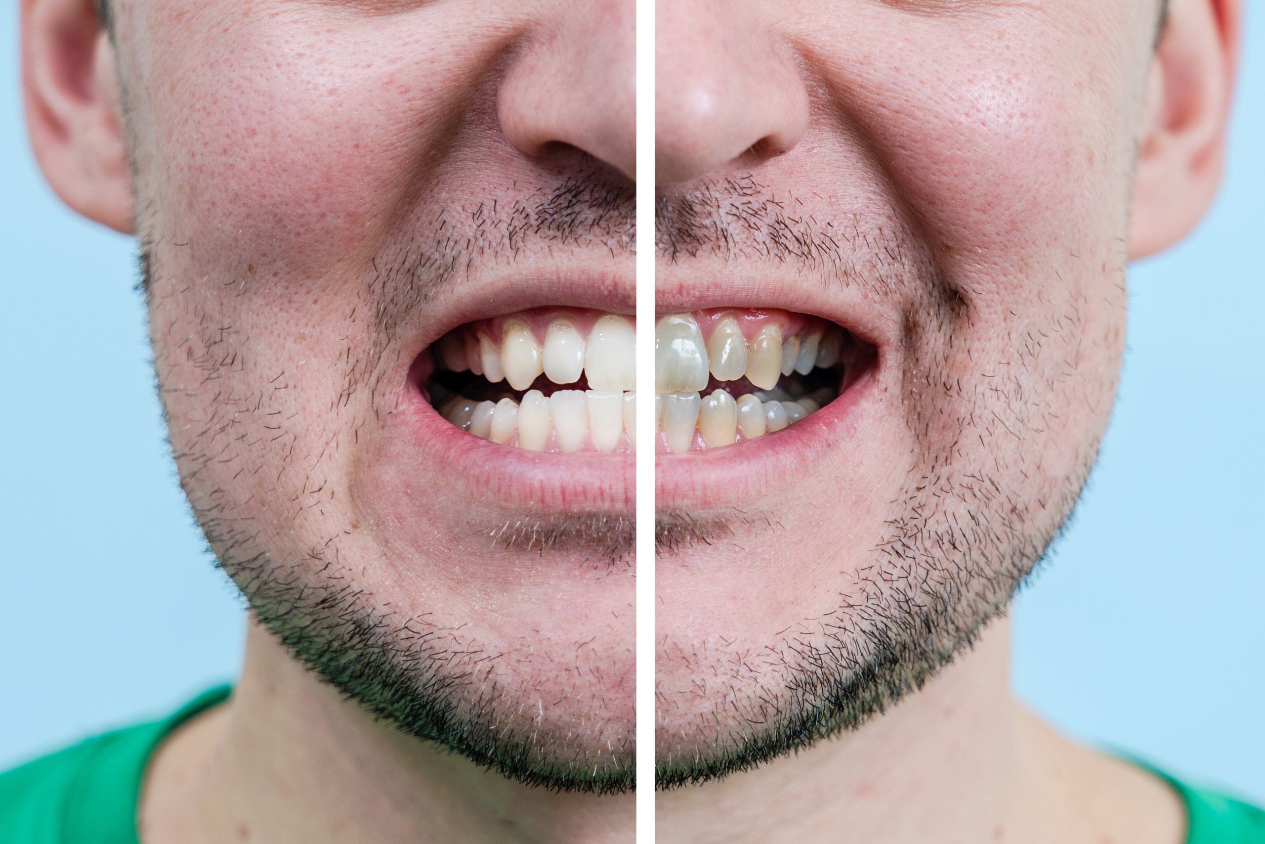 Man Teeth Before And After Whitening. Dentist work photo
