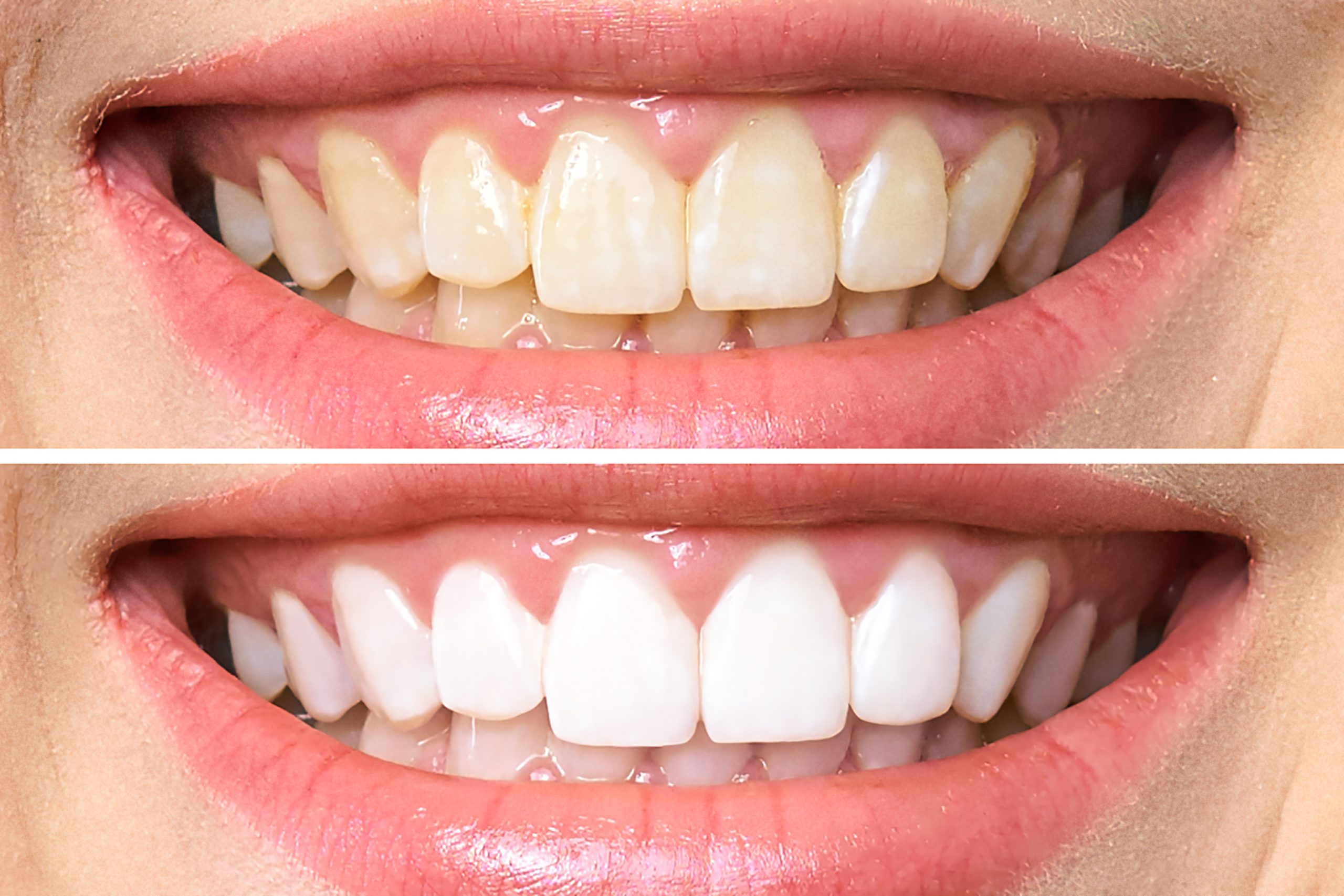 woman teeth before and after whitening. Over white background. Dental clinic patient. Image symbolizes oral care dentistry, stomatology.