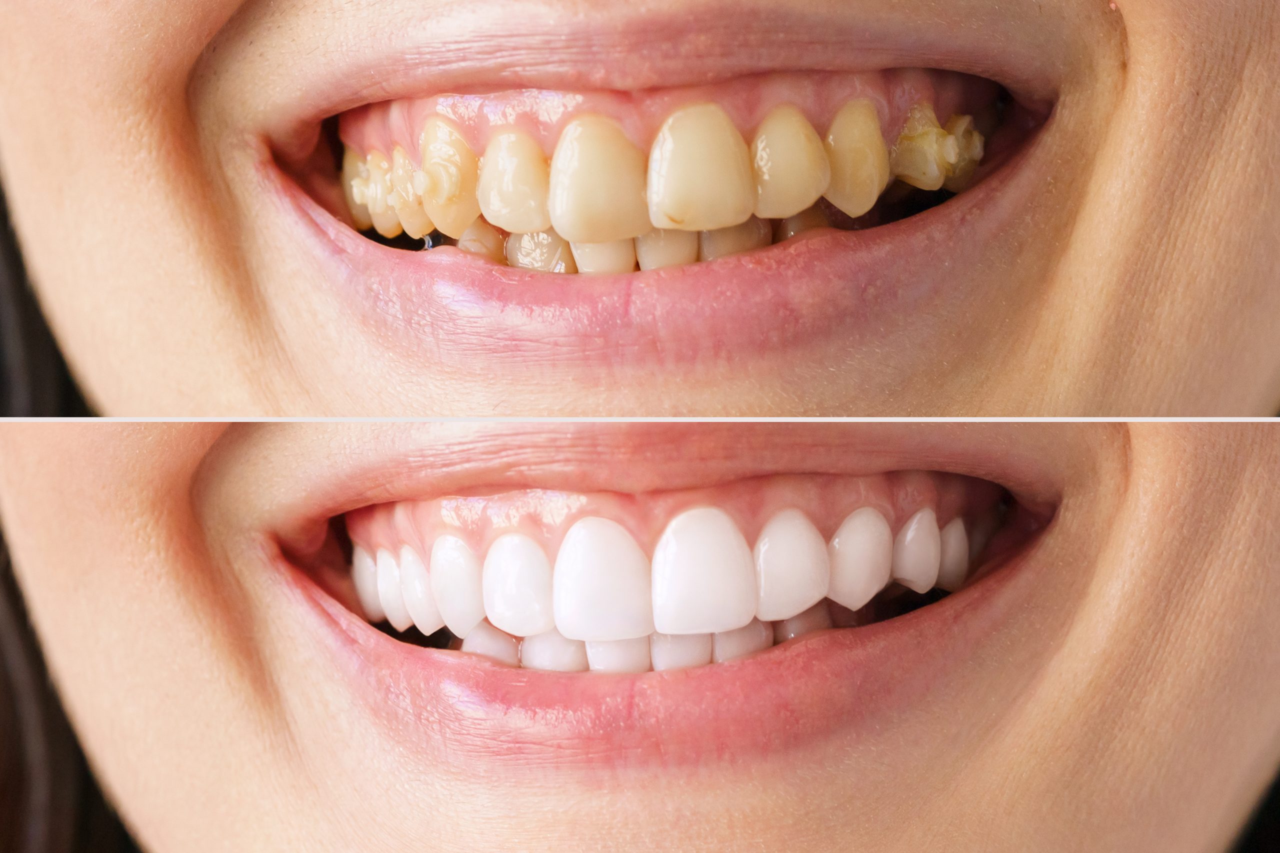 A woman's smile in close-up, before and after the bleaching procedure at the dentist